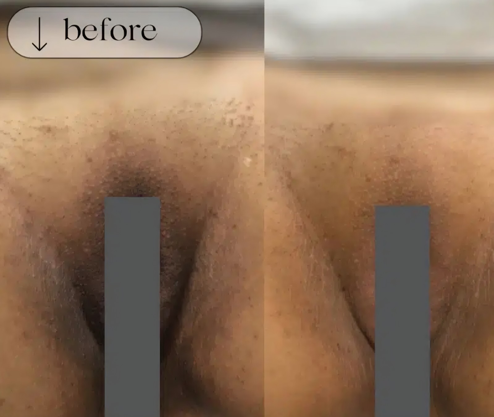 Intimate Areas Skin Lightening Bleaching Cream, Underarms, Butt, NOT For FACE