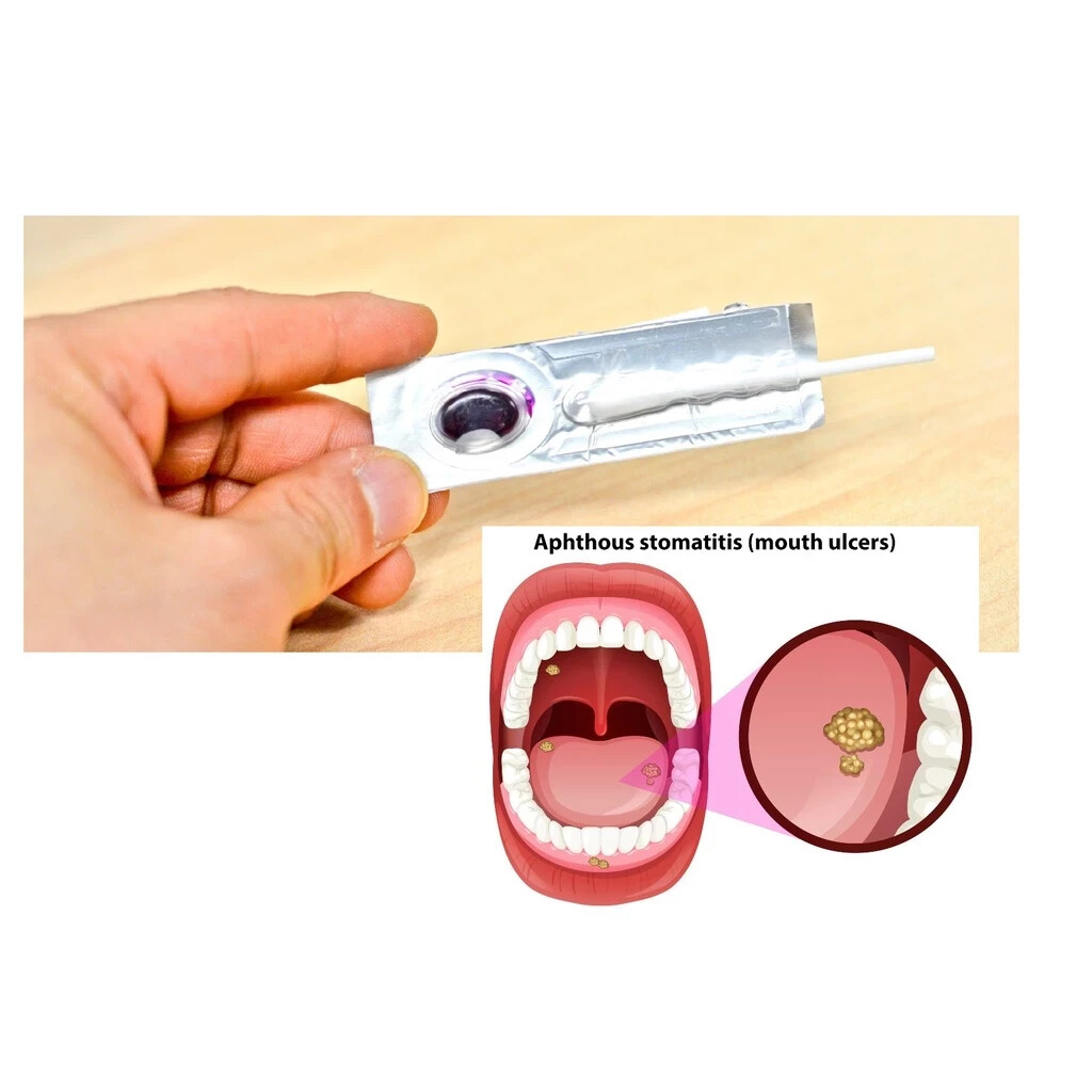 3 Box Oralmedic Mouth Ulcer Gel 1 Treatment Fast Pain Relief Made in USA
