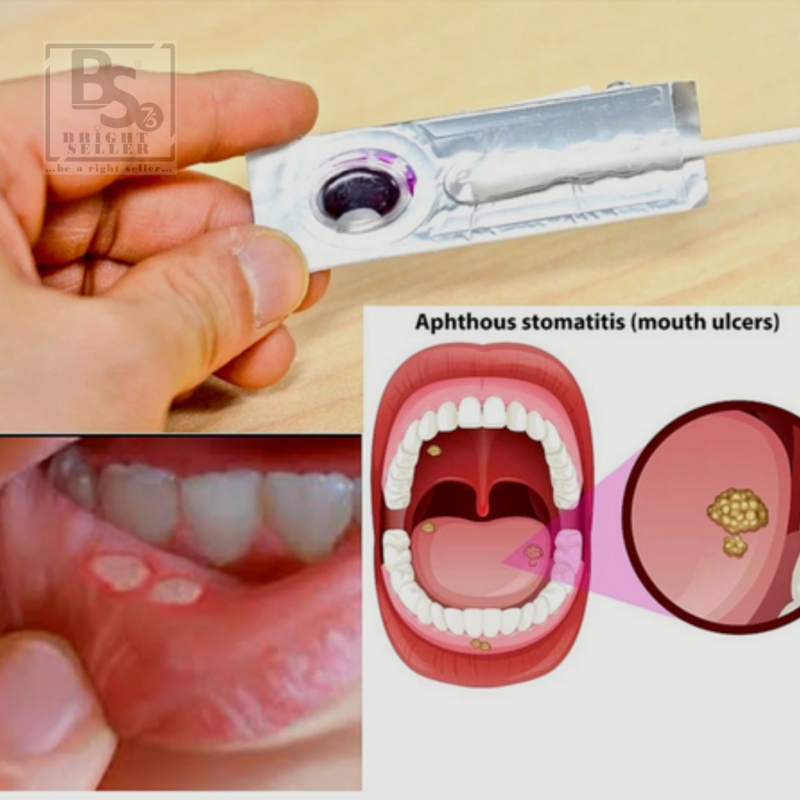 ( Pack of 6 ) Oralmedic Mouth Ulcer Gel 1 Treatment Fast Pain Relief – FREE Gift