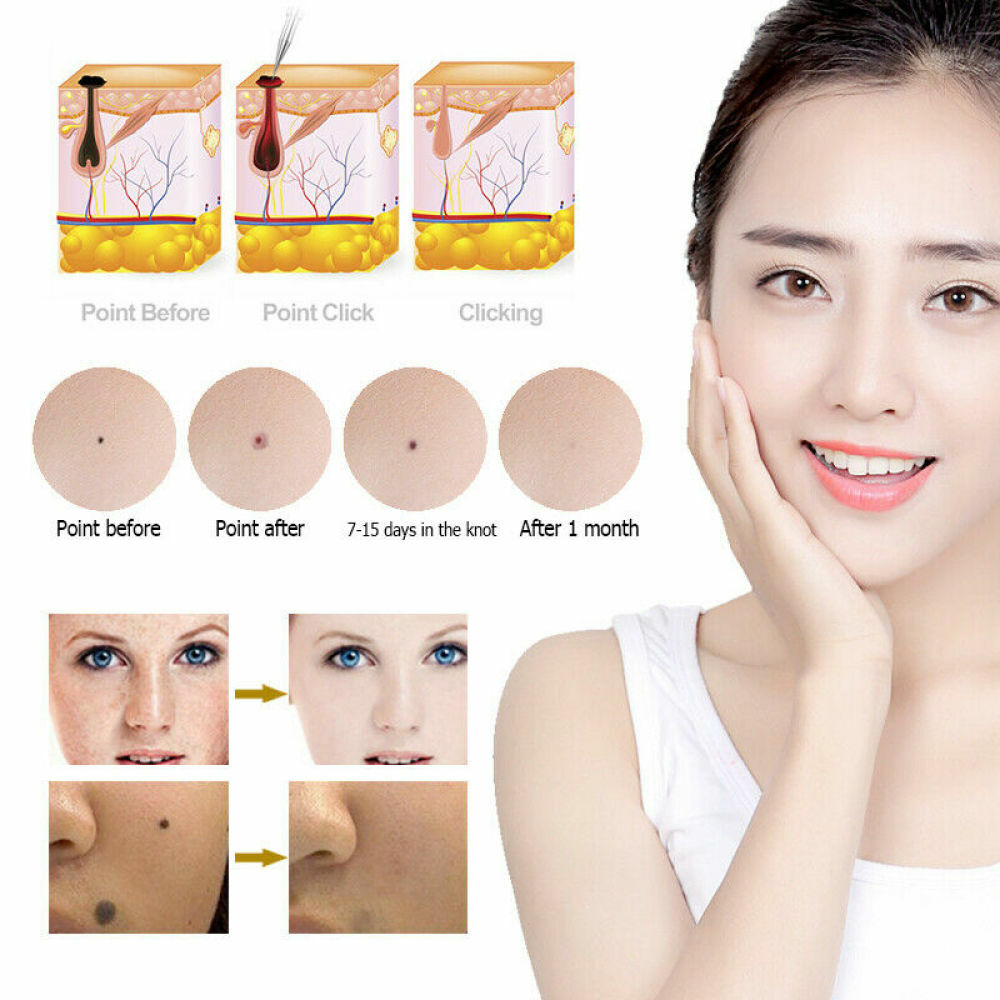 9 level Laser Plasma Pen Mole Removal Dark Spot Skin Tag Tattoo Wart Remover Pen