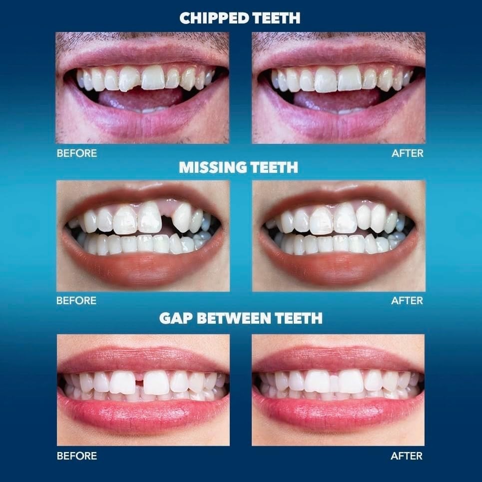 Tooth Tinted Plastic Temporary Tooth Fill Kit for Chipped Gaps Natural Color