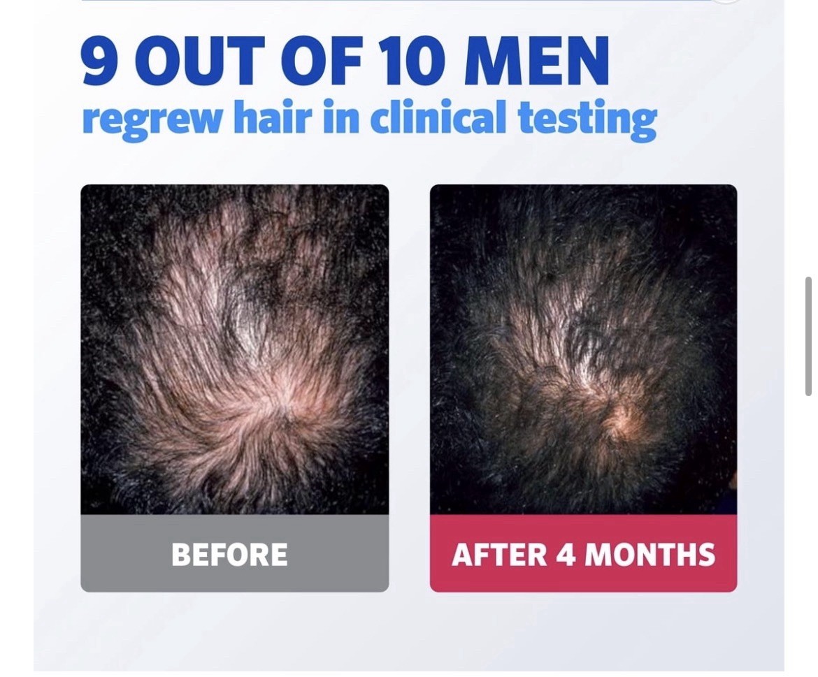 Rogaine Men’s 5% Minoxidil Foam Hair Regrowth Treatment Unscented 2.11 oz