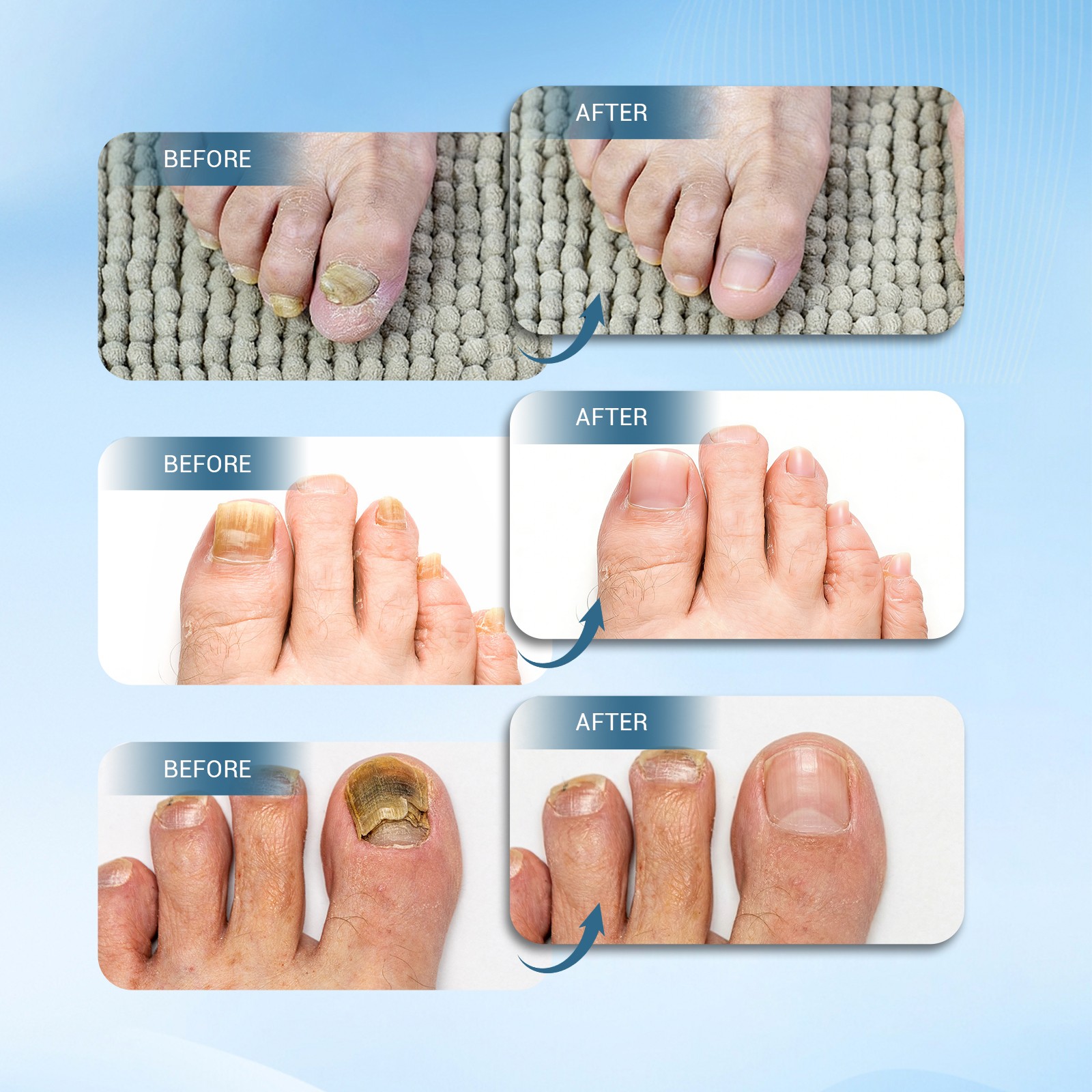 470nm+905nm Laser Nail Fungus Physiotherapy Device for Toenail Fingernail Care