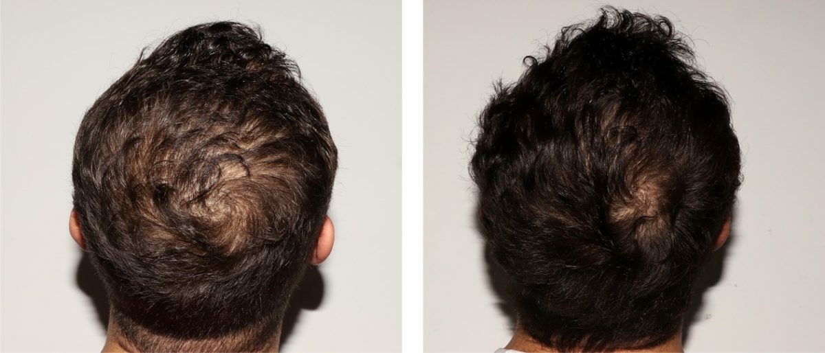 Hair Growth Oil Serum DHT-Alopecia-Thinning Hair-Balding 2oz.(60ml)ALL ORGANIC