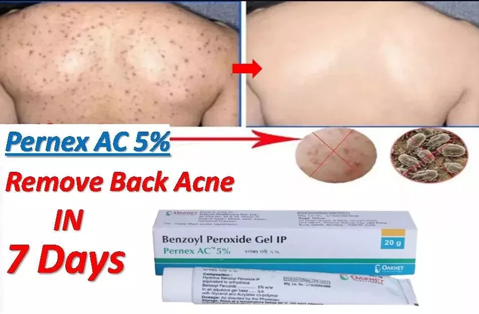 (PACK OF 2) New Pernex AC 5% Gel Benzoyl Peroxide For Back Acne & Pimple 20GM