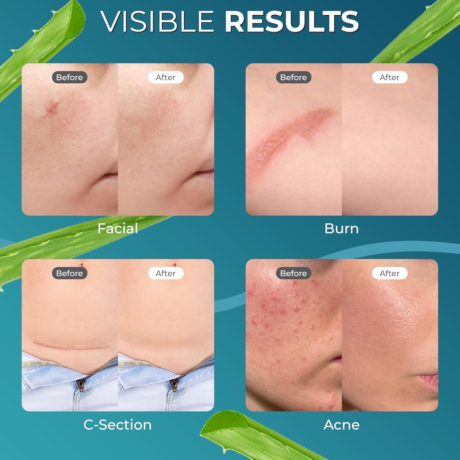 Scar Removal Silicone Tape for Hypertrophic Scars & Keloids, 1.6” x 150”