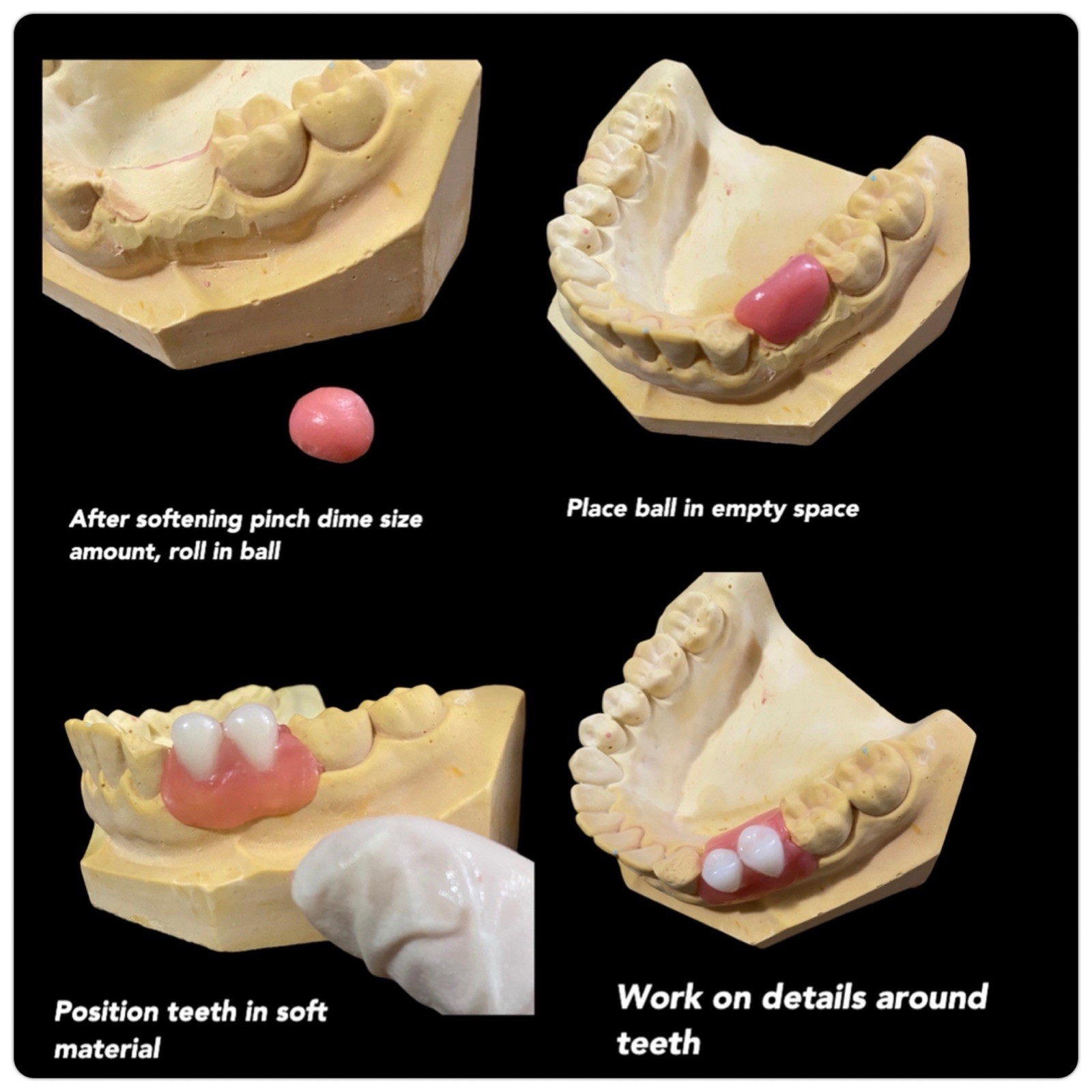 DIY DENTURE Full/Partial Standard Kit Upper Lower Beginners Alginate Impression