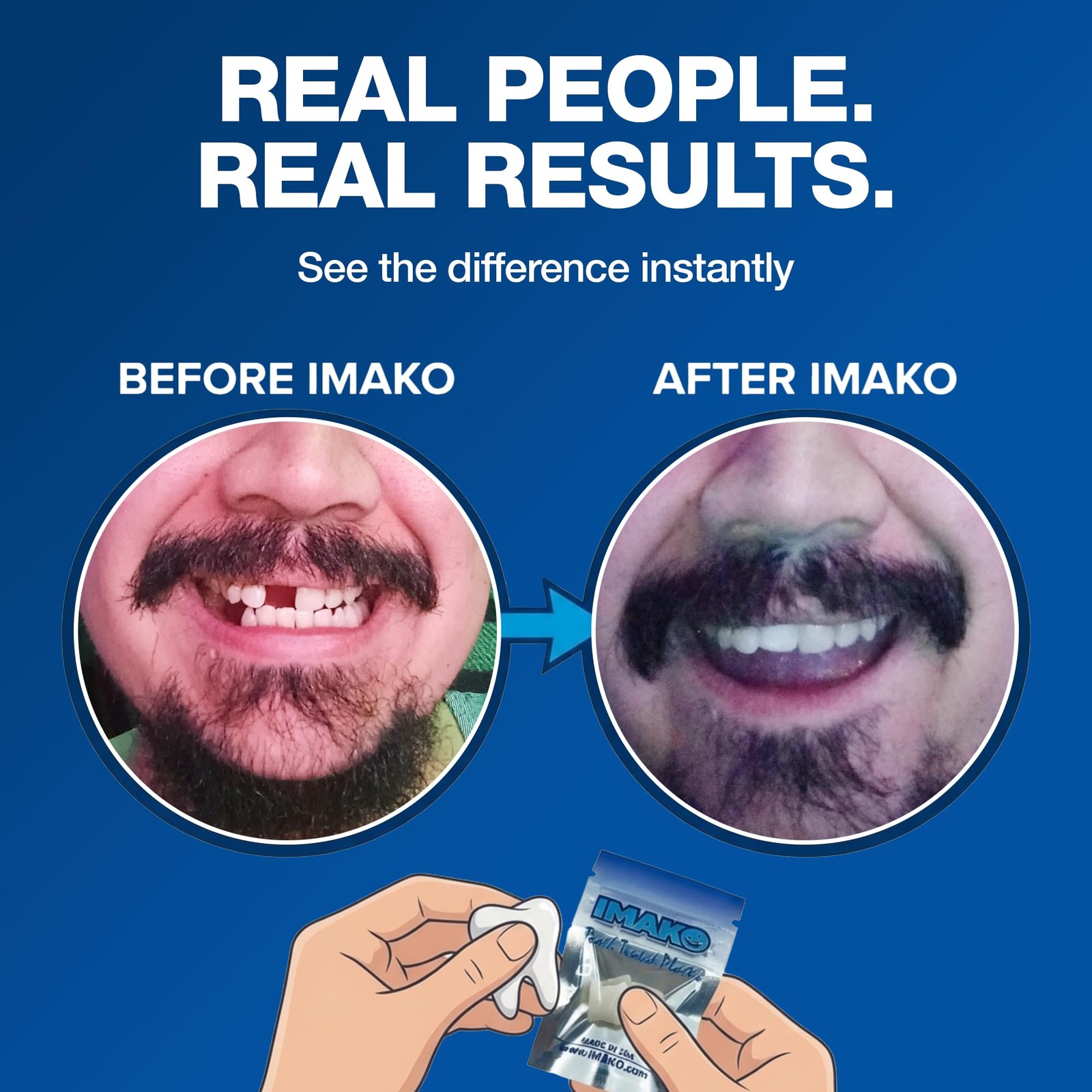 Imako Tooth Tinted Plastic – Natural Color – Temporary 1 Count (Pack of 1)