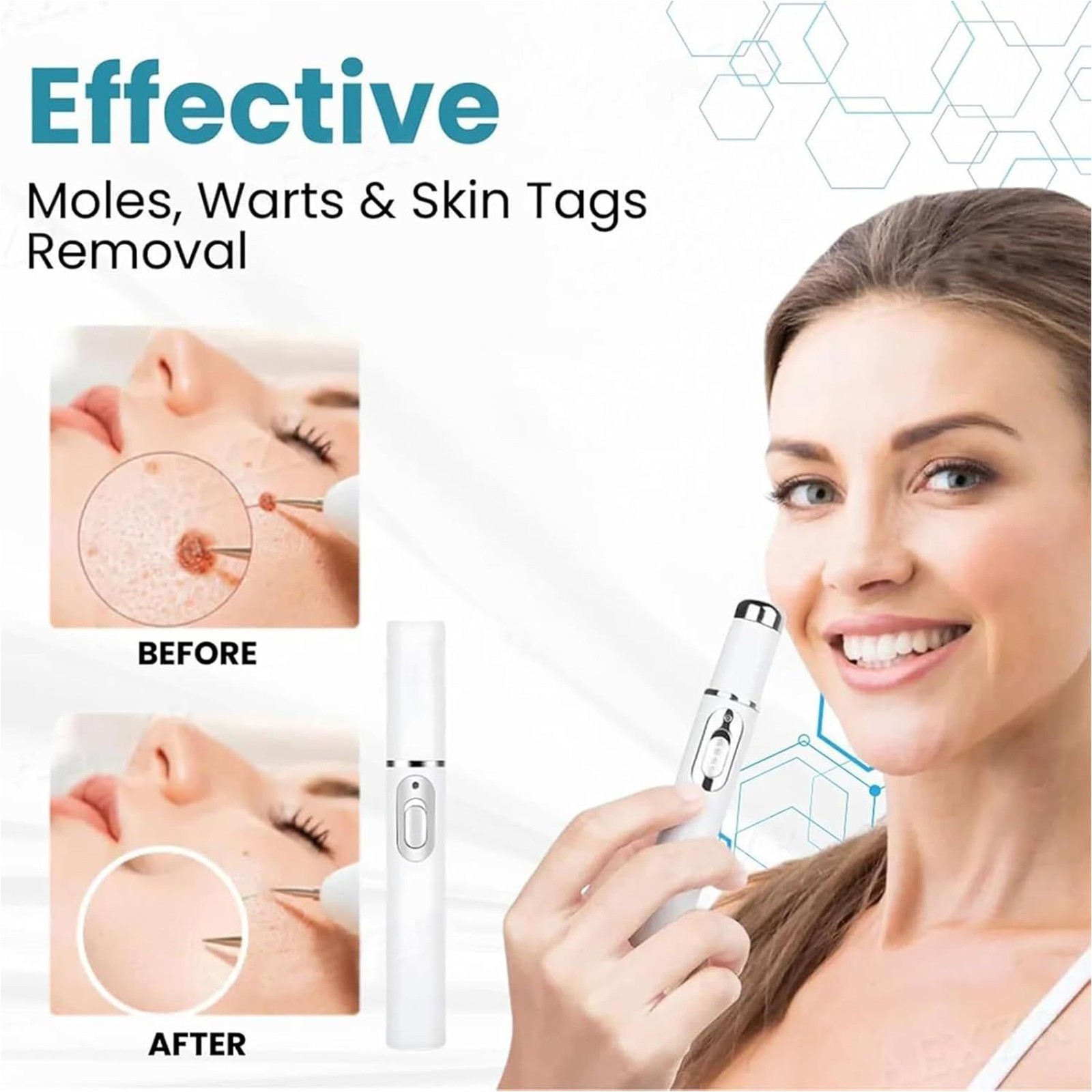 Non-Invasive Mole and Wart Removal Laser Pen, Advanced Skin Tag Removal Pen