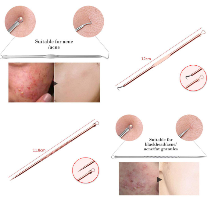 Blackhead Remover Pimple Comedone Extractor Tool Best Acne Removal Kit – Treatme