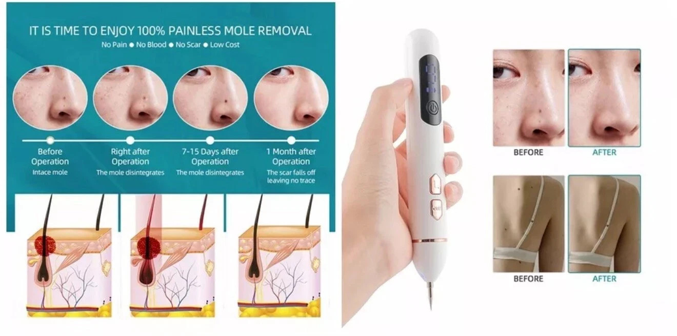 Laser Plasma Pen Mole Removal Dark Spot Remover Skin Wart Tag Tattoo Anti-Aging