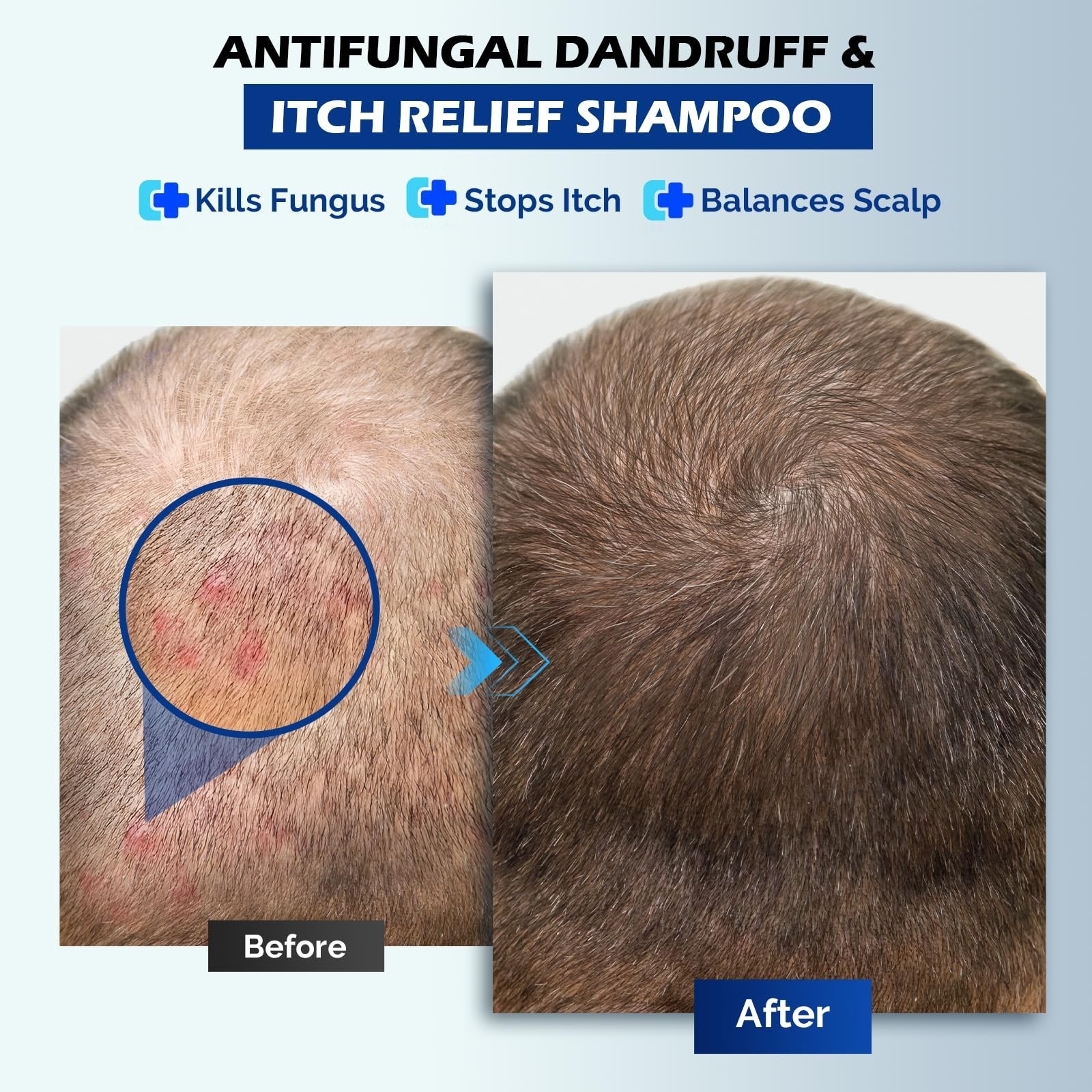 Antifungal Shampoo for Scalp Psoriasis, Dandruff & Itchy Scalp Relief – 10.1 Fl