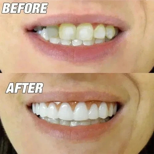 Share Smile Snap On False Teeth Upper Lower Dental Veneers Denture Tooth Cover S