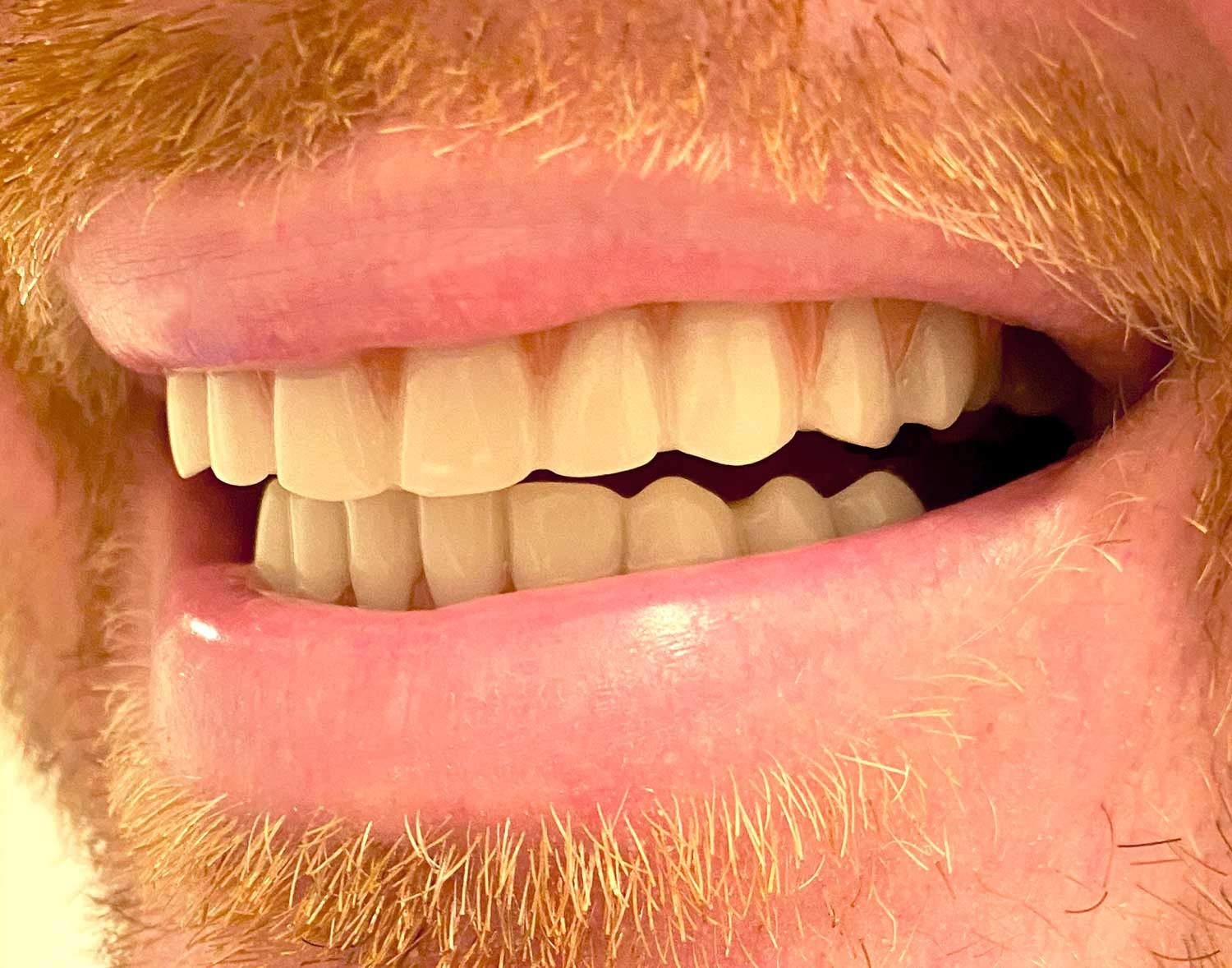Handmade Natural Shade Teeth Kit – Upper & Lower Match