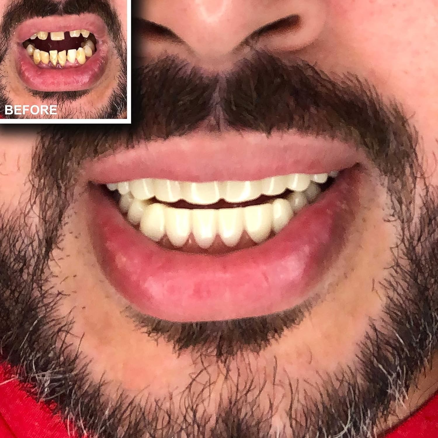 Handmade Natural Shade Teeth Kit – Upper & Lower Match