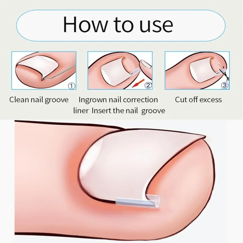 Ingrown Toenail Correction Patch Ultra Thin Elastic Nail Treatment Sticker Tool
