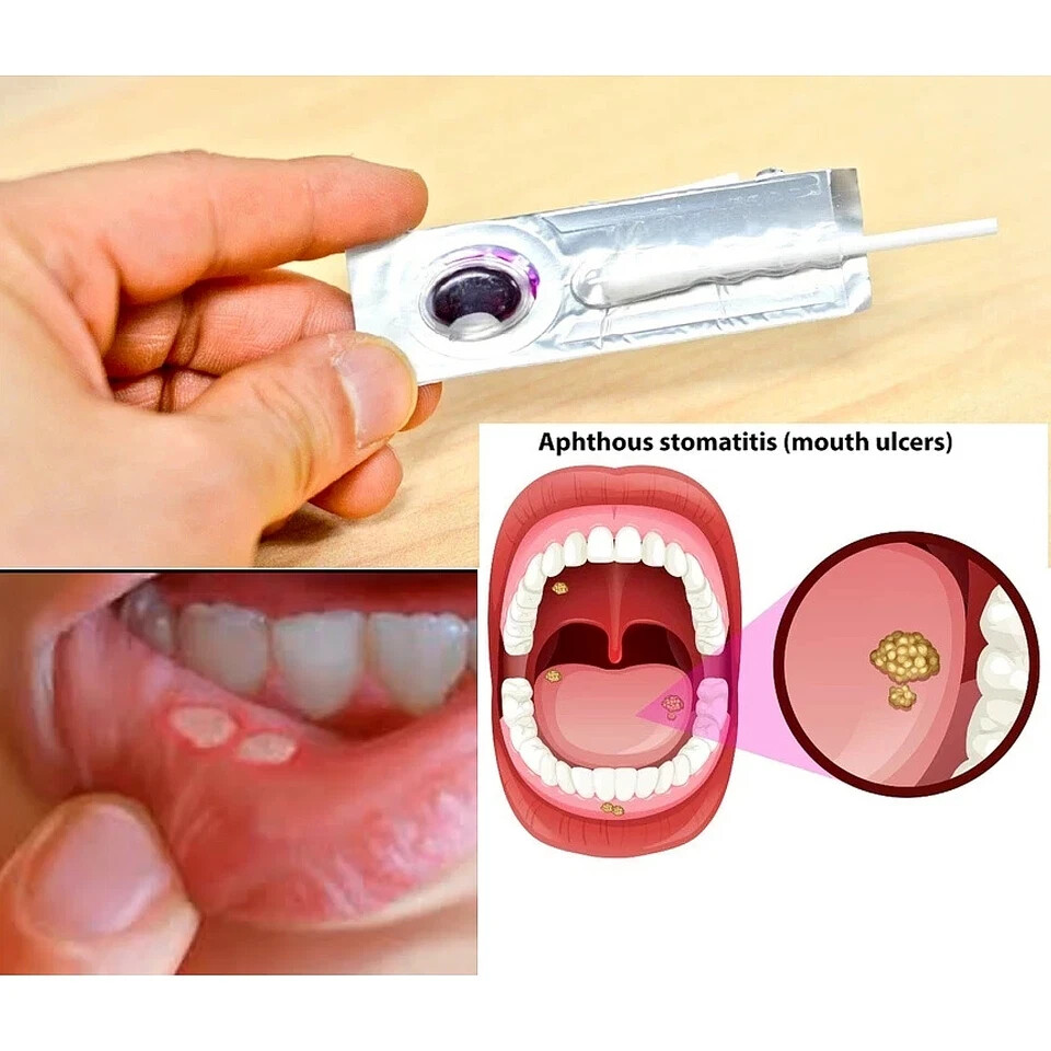 Oralmedic Mouth Ulcer Gel 1 Treatment Fast Pain Relief ( X 2 )