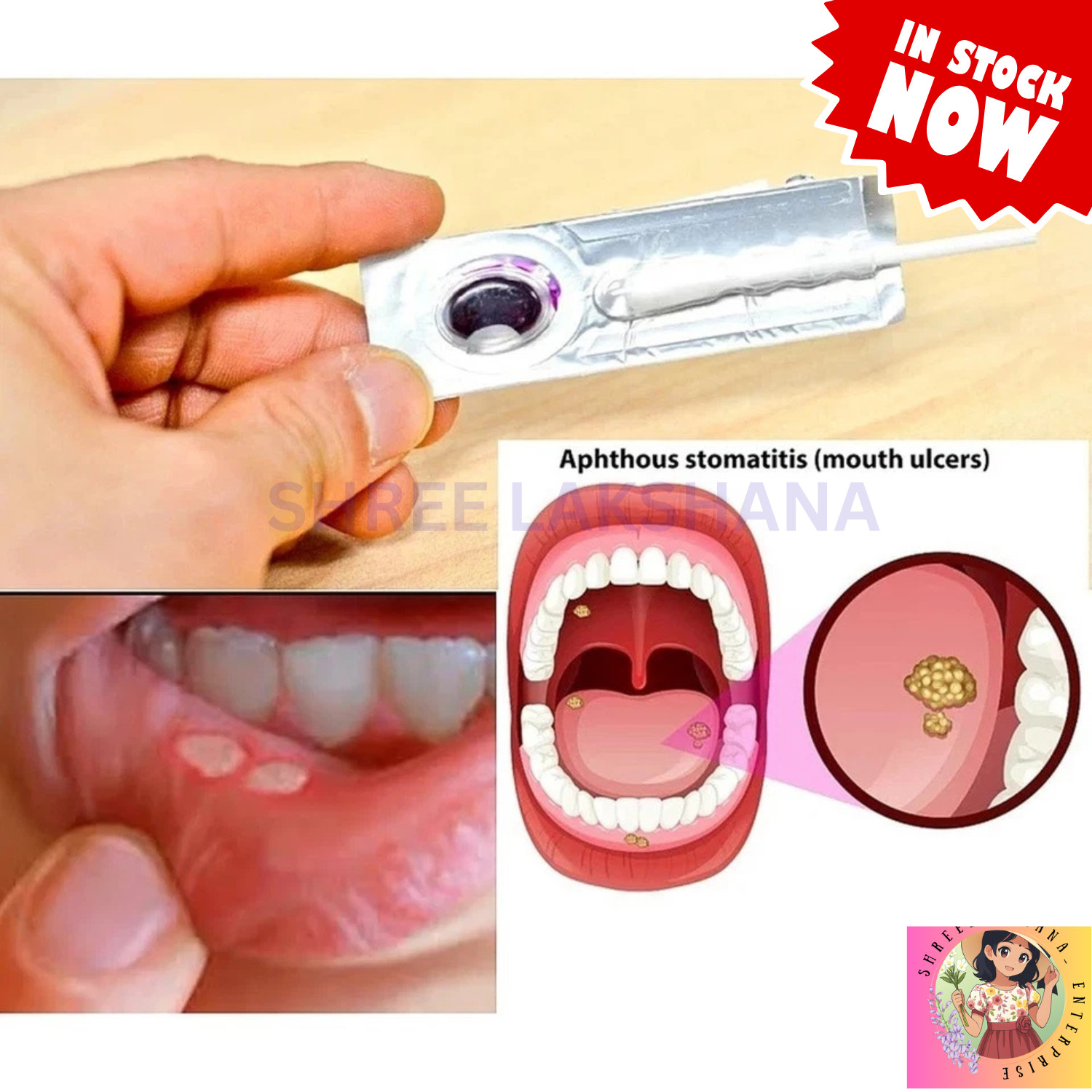 Oralmedic Mouth Ulcer Gel Fast Pain Relief Single Treatment 6 Packs USA