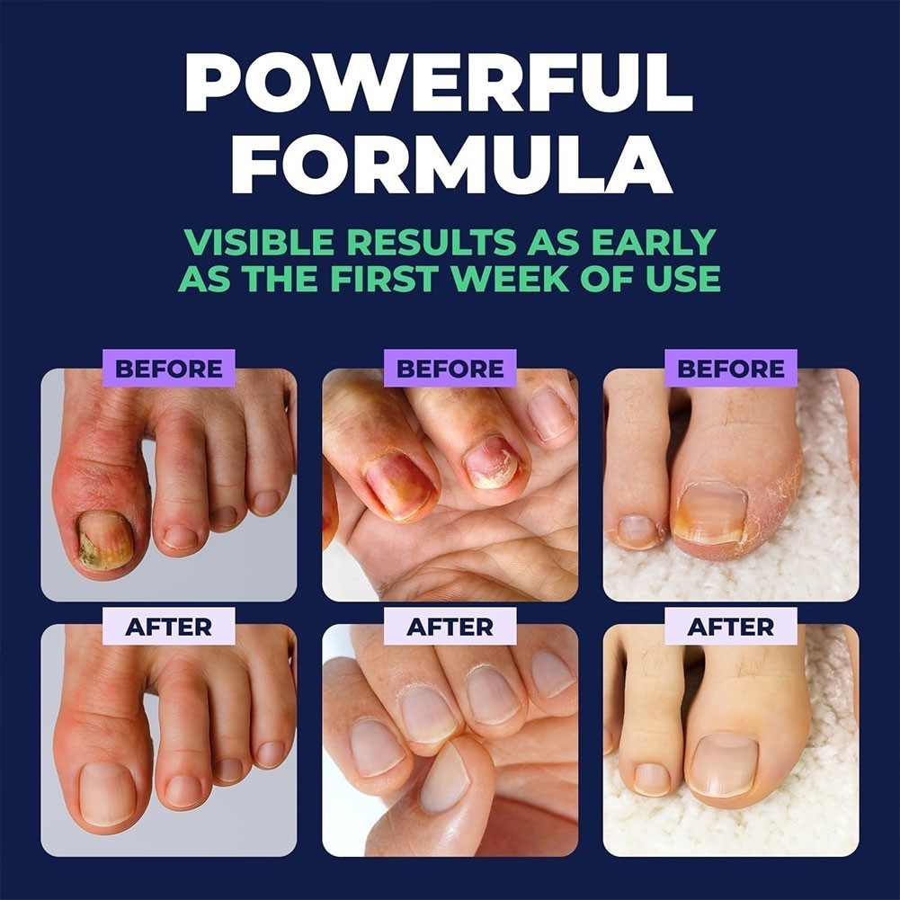 Orivelle Anti Pen, Clear Anti Fungal Pen, Anti Fungal Nail 3ml