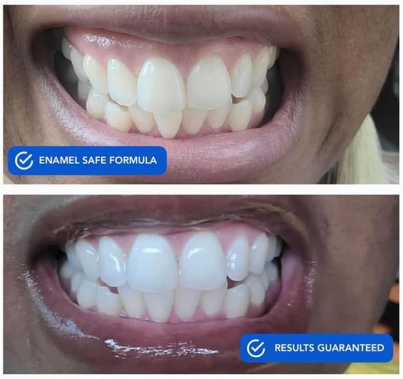 SNOW Diamond Dissolving Teeth Whitening Strips – Gentle & Enamel Safe White