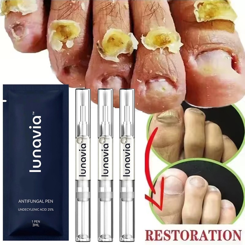 15/6/3PCS Lunavia Antifungal Pen 25% Undecylenic Acid – Toenail Fungus Treatment